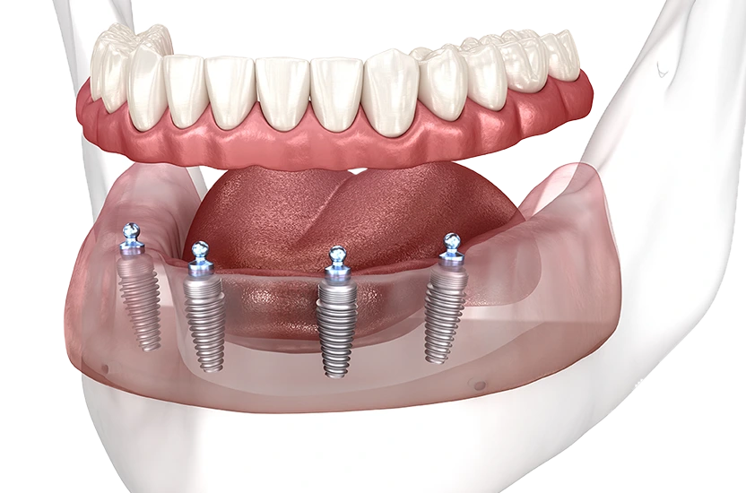 Image of a full arch of teeth being secured with four dental implants.
